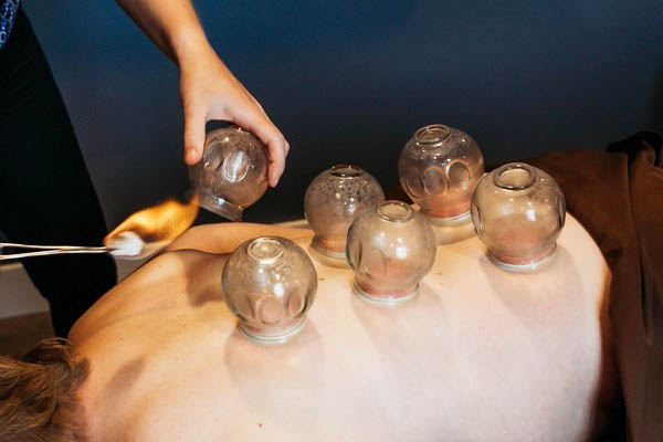 Cupping Therapy 5