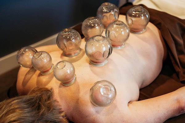 Cupping Therapy 6