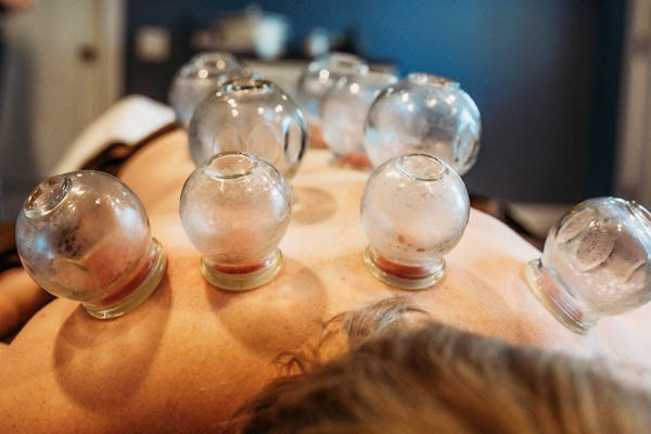 Cupping Therapy 7