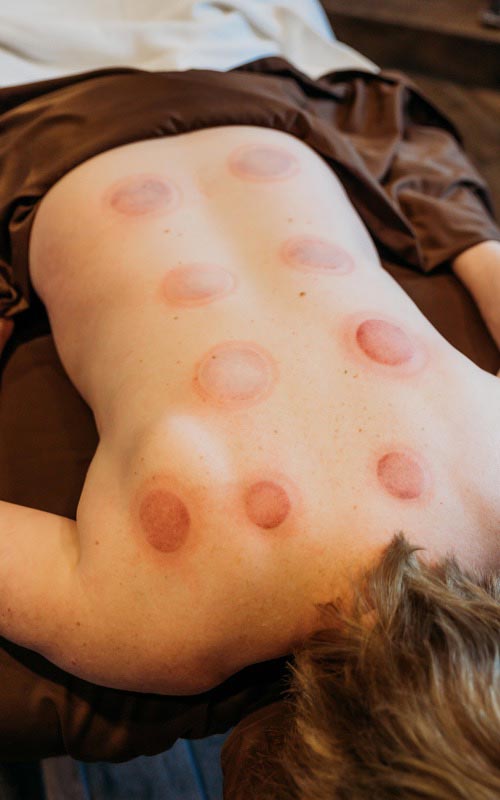Cupping Marks